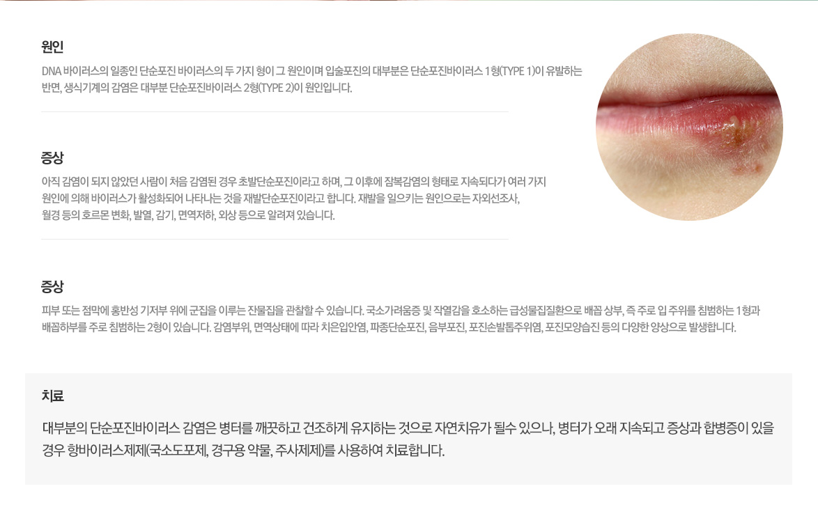 단순포진_설명