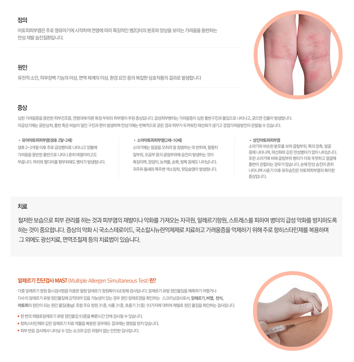 아토피피부염_설명