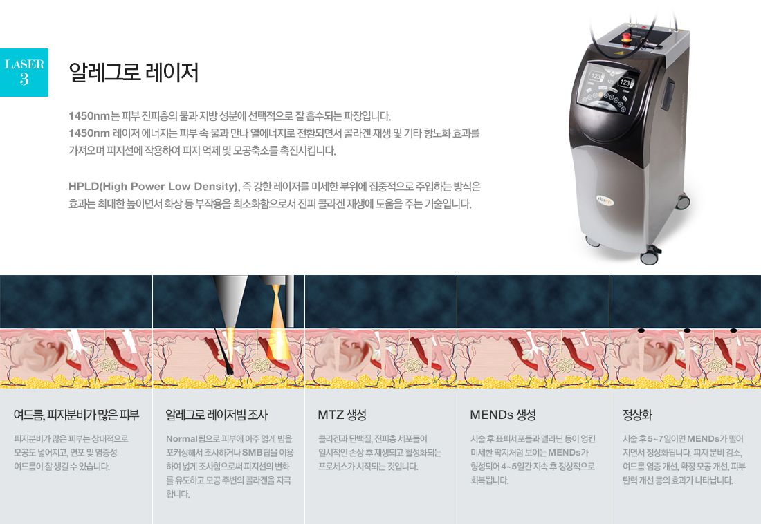 laser3. 알레그로 레이저